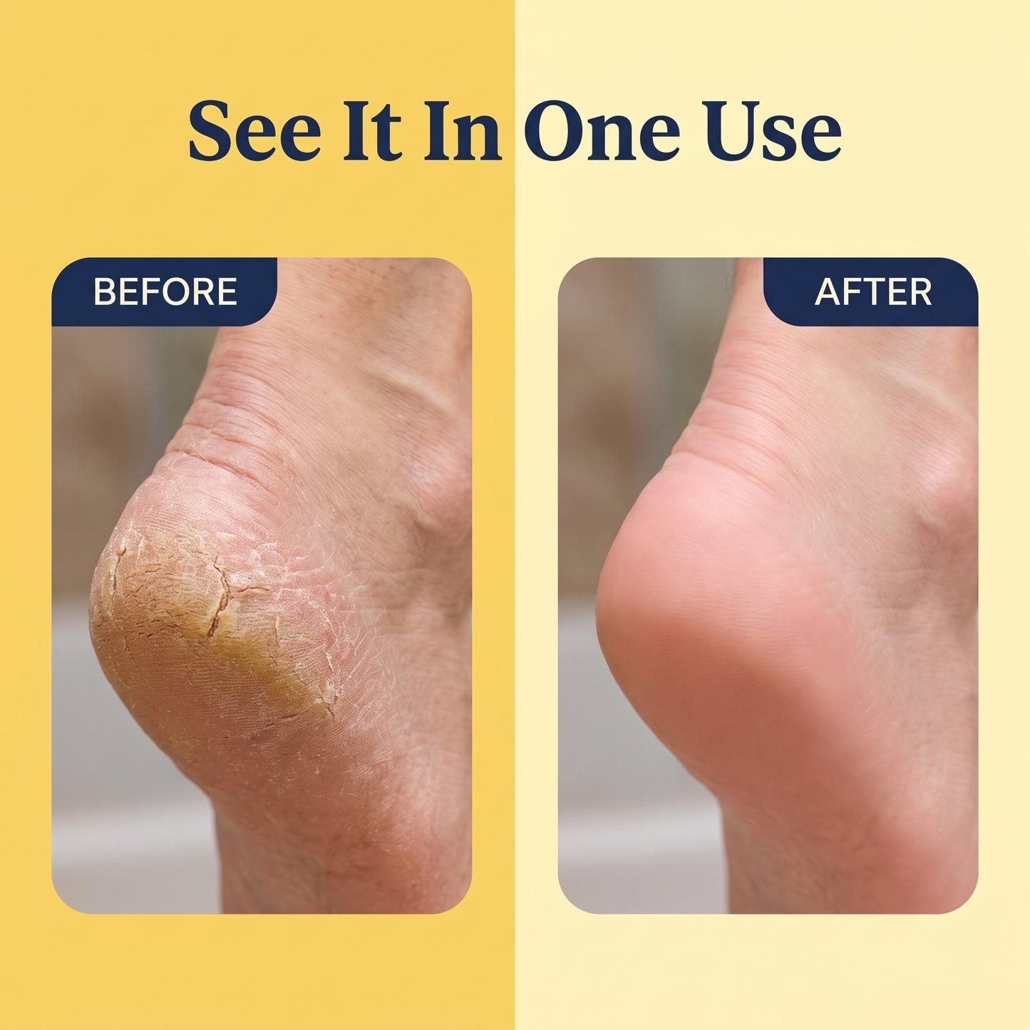 Dual‑Sided Foot Callus Remover
