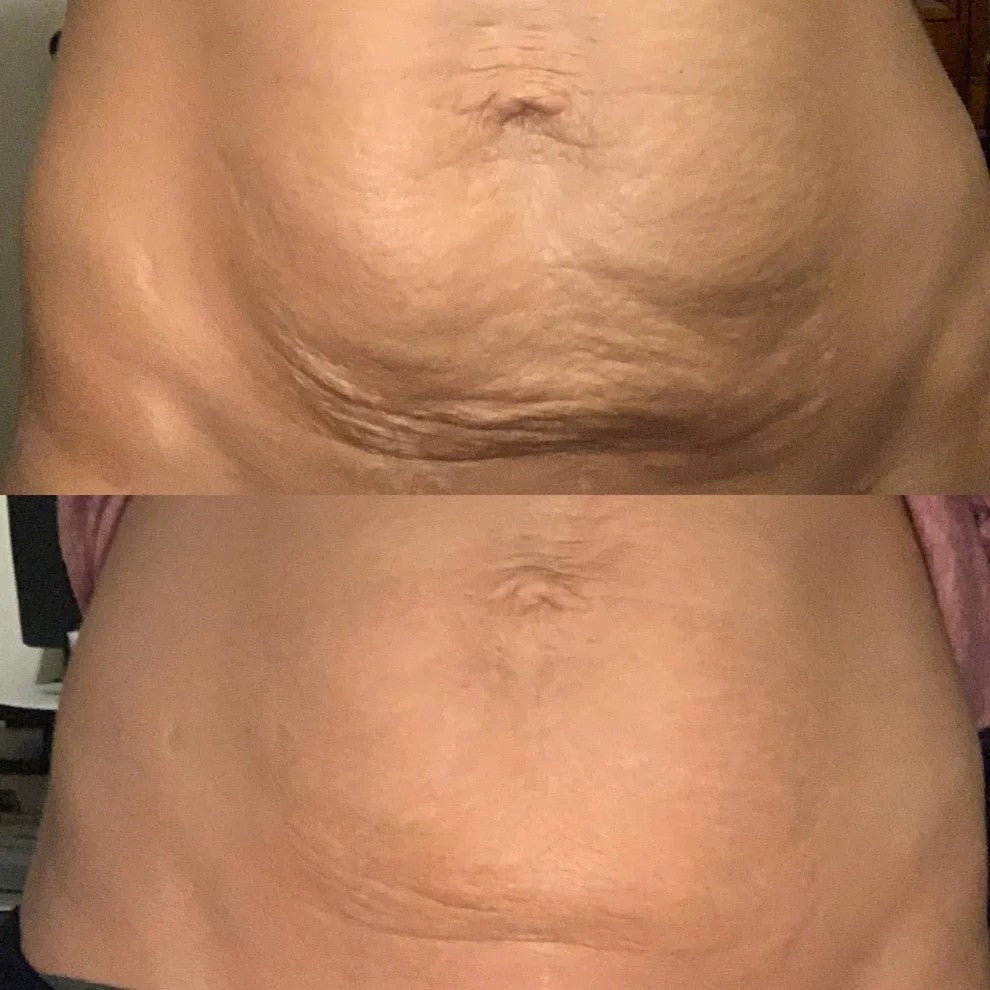 Anti-Cellulite Oil